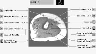 MRI ARMFOREARM ANATOMY DrAHMED EISAWY [upl. by Largent]