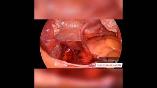 LAPAROSCOPIC ABDOMINO PERINEAL RESECTION APR FOR LOWER RECTAL CANCER [upl. by Eissirc]