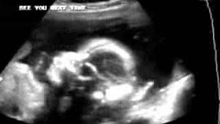 22 weeks pregnant ultrasound sonogram [upl. by Kirsti377]