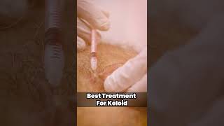 How to treat keloid scar  Keloid Removal Treatment at Skinaa Clinic viral shorts [upl. by Otila785]