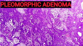 Benign Mixed Tumour of Salivary Gland  Pleomorphic Adenoma Histopathology [upl. by Naldo]