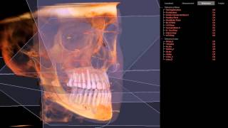 3D Cephalometric Analysis [upl. by Yenffit242]