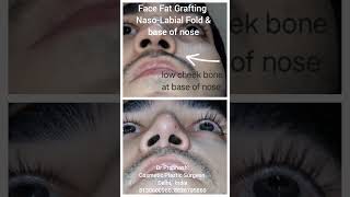 Face Nose Cheek Fat Grafting Asymmetry Correction in Delhi fatgraftingsurgery  nose  nosetip [upl. by Lahcim]