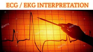 ECGEKG Interpretation part 6  Ischemia and Myocardial Infarction in ECG [upl. by Ayot]