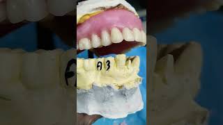 Upper Complete Denture 😁😁😁 Teeth Arrangement By Haider 😁😁😁 [upl. by Norrej]