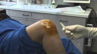 Knee Injection HDmp4 [upl. by Mall]