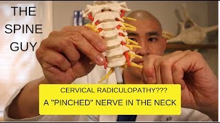 CERVICAL STENOSIS RADICULOPATHY PART 1  SYMPTOMS IMAGING AND PATIENT EXAM [upl. by Drus203]