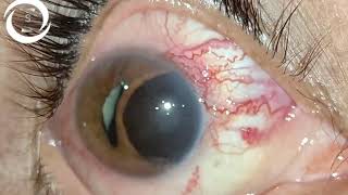 Ciliary body melanoma [upl. by Leiram]