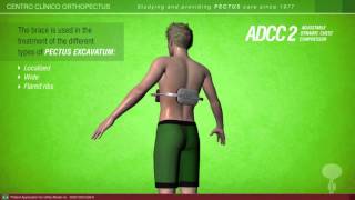 ADCC 1 and 2 braces for pectus carinatum and excavatum An Orthopectus invention [upl. by Marthena299]