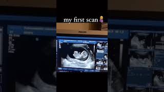 Ultrasound scan baby movement in womb pregnancycare pregnancy ultrasound [upl. by Cence976]