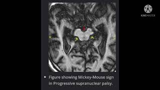 MRI Basics  Types of MRI  some important findings part 1 [upl. by Bbor]