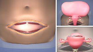 Abdominal Myomectomy through Maylard incision  TVASurg [upl. by Albrecht566]