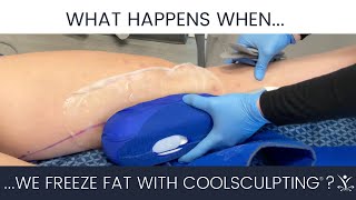 CoolSculpting Inner Thighs [upl. by Aicilat]