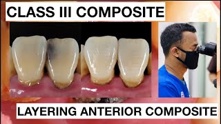 Step by Step Class III Composite Restoration  Dentist Griya RR [upl. by Auqenwahs]