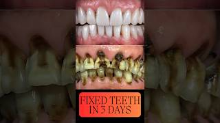 Teeth Fixed In Just 3 Days dentalesthetics dentalclinic implants dentalcare [upl. by Marmion]