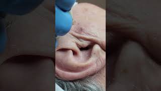 Seborrheic Keratosis Removal Philadelphia [upl. by Ttenna756]