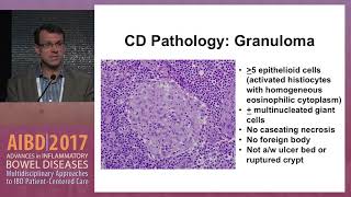 Use of endoscopy to evaluate esophageal gastric and duodenal Crohn’s disease [upl. by Aennil235]