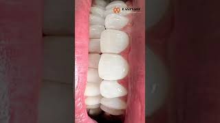 Teeth Whitening Before amp After [upl. by Amara]