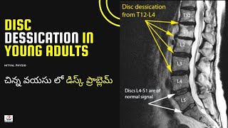 Disc Degeneration L5 S1 Disc Desiccation Disc Degeneration Causes DDDDegenerative Disc Treatment [upl. by Arat]