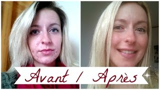 ACNE ❀ Roacutane mois après mois [upl. by Remde]