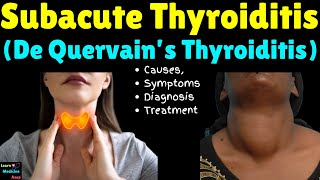 Subacute Thyroiditis De Quervain’s Thyroiditis – Causes Symptoms Diagnosis and Treatment [upl. by Hehre699]