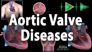 Aortic Valve Disease Animation [upl. by Cathyleen]