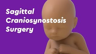 Sagittal Craniosynostosis Surgery [upl. by Serge]