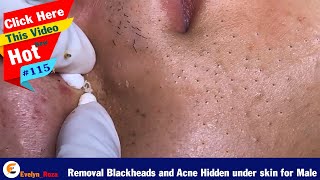 Removal Blackheads and Acne Hidden under skin for male  Acne Treatment 115 [upl. by Ecinom]