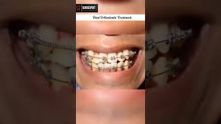 Fixed Orthodontic Treatment for Class II Malocclusion shorts dentist orthodontic dental viral [upl. by Legir]