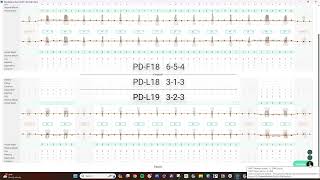 Voice Enabled Perio Charting amp PHI Reporting for ISO Standalone Denti AI Voice [upl. by Eda370]