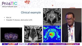 ProsTIC24  Dan Moon Diagnosis of Prostate Cancer with PSMA PETCT [upl. by Hermy]