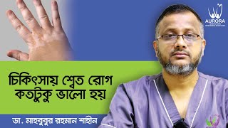 Vitiligo treatment in Bangladesh  Vitiligo treatment bangla  বাংলাদেশে শ্বেত রোগের আধুনিক চিকিৎসা [upl. by Brom781]