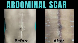 Abdominal scar treatment Scar treatment in Ranchi Removal of scar on abdomen scar abdominalscar [upl. by Sami]