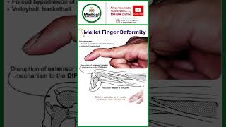 Mallet finger ddeformity [upl. by Ocicnarf14]