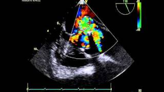 AORTIC DISSECTION ECHOCARDIOGRAPHY [upl. by Stormy]