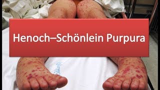 HenochSchönlein Purpura [upl. by Eloc]