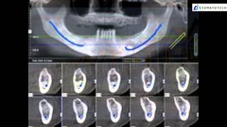 Dental implants amp Cone Beam CBCT for general dentists  markers [upl. by Kelcy498]