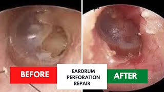 Successful repair of eardrum perforation [upl. by Aivan]