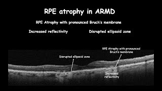 Clinical changes in RPE RPE rip and Atrophy [upl. by Bridie862]