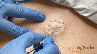 Removal of an epidermal cyst on the back [upl. by Nybbor624]