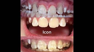 Icon infiltration minimally invasive therapies for anterior teeth with enamel defects MITFATWED [upl. by Hobbs]