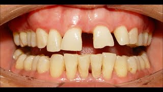 Orthodontic Treatment of Severe Median Diastema Ekhlas 37yrs [upl. by Phelgen506]