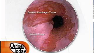 Barretts Esophagus [upl. by Dore]