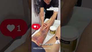 Hematoma en la Pierna Efecto de la Gravedad en una Rotura Muscular 🚑 [upl. by Reh]