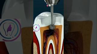 Root Canal treatment rootcanalspecialist rootcanals rootcanaltherapy dental cosmeticdentistry [upl. by Eidnarb]