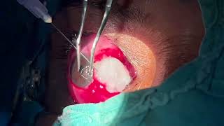 Modified Pterygium Surgery  Wills Hospital USA with Conjuctival Autograft using Mitomycin C [upl. by Haimes]