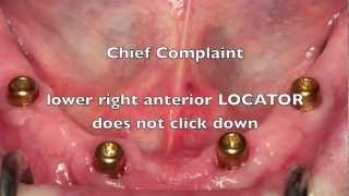 NEW Locator Dental Implant Attachments  Workshop Tips [upl. by Pelligrini804]