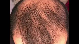 8 months using minoxidil  Rogaine 5 Before amp After results [upl. by Resaec]