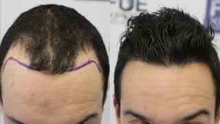 FUE Hair Transplant 2218 grafts in NW lllA  Scarring Alopecia Dr Juan Couto  FUEXPERT CLINIC [upl. by Map]