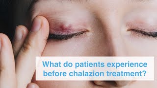 What do patients experience before chalazion treatment [upl. by Lashonde]